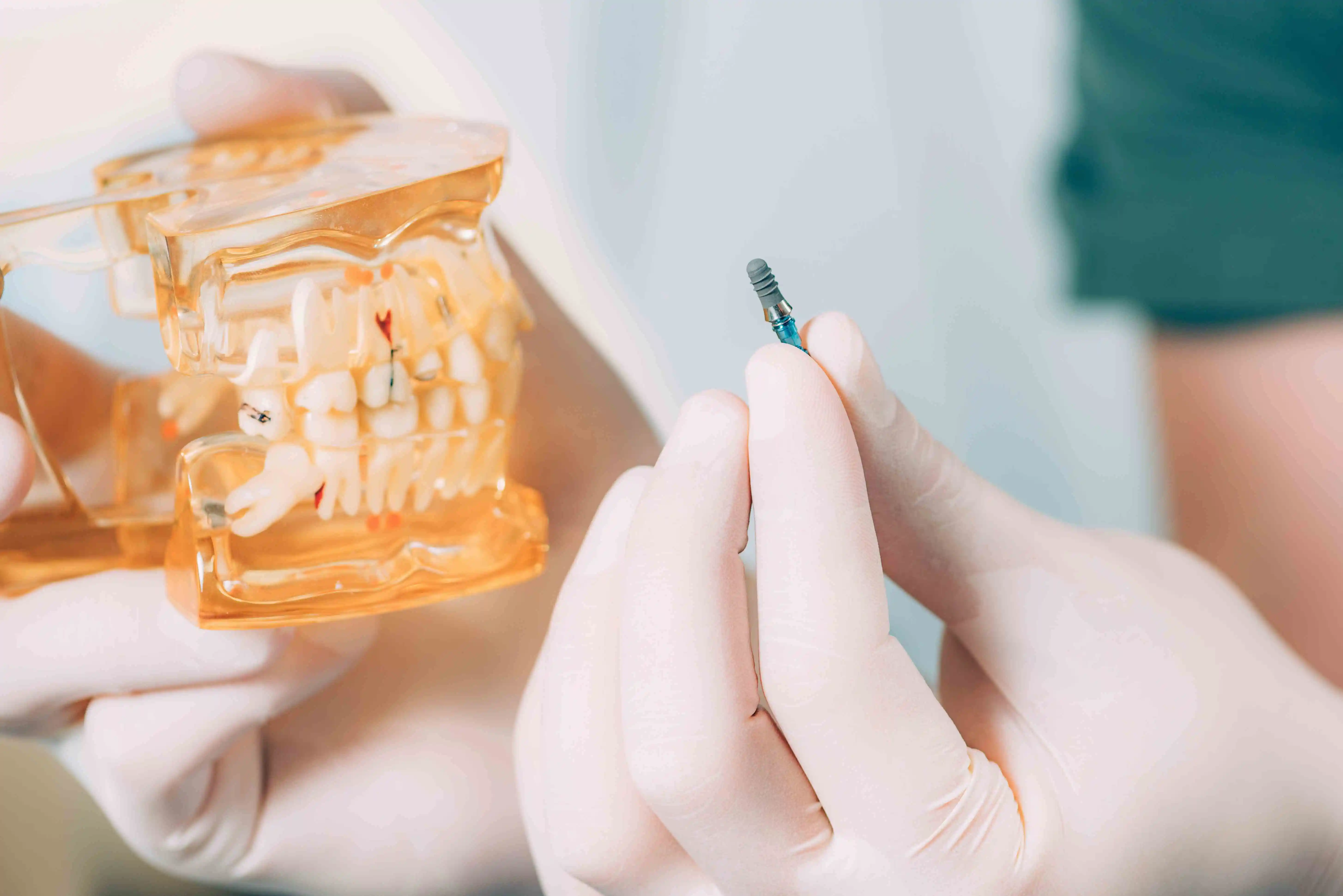 Teeth Replacement Options dentist holding dental implants