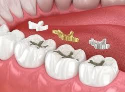 Gold Fillings