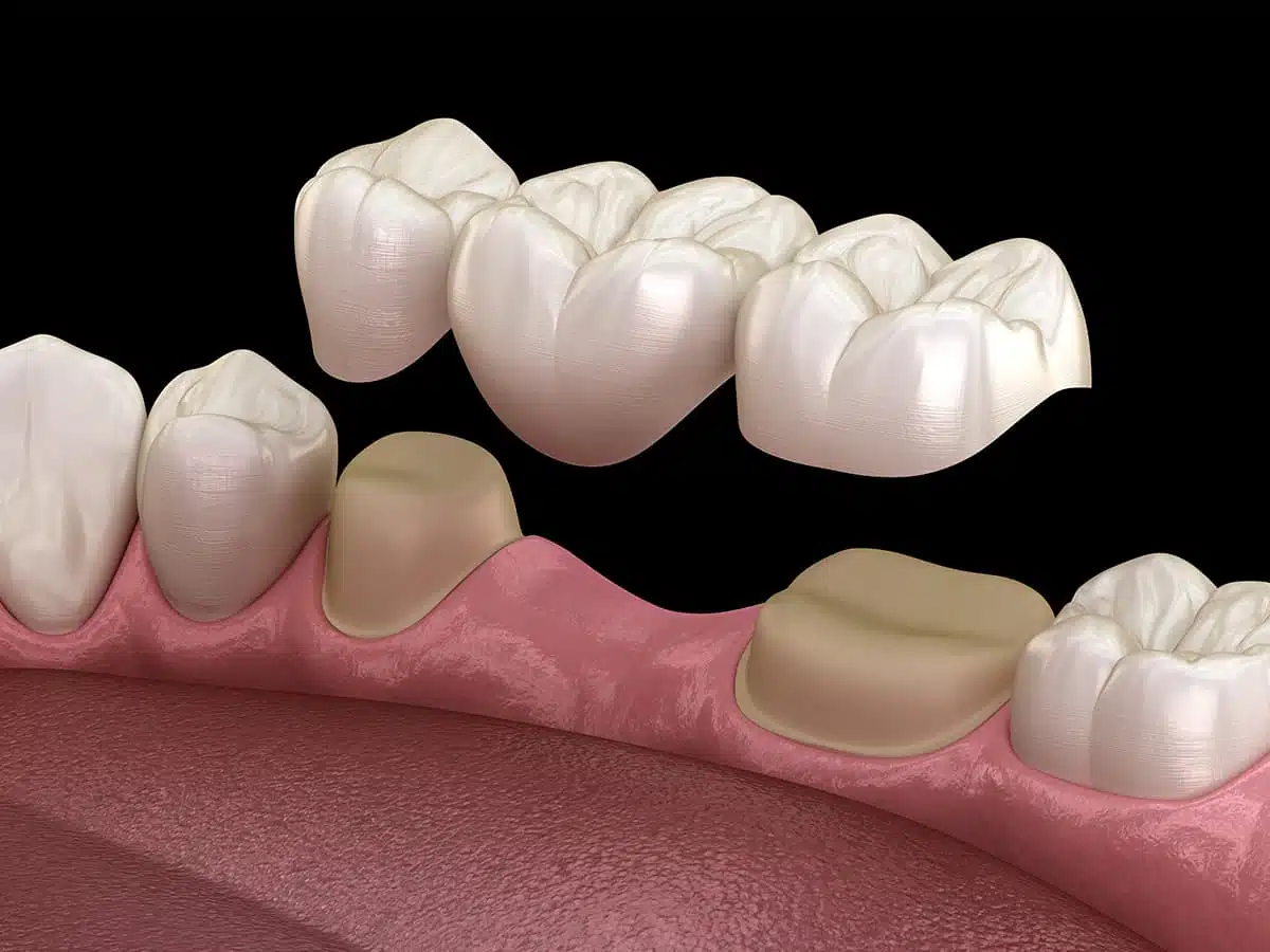 Restore your Smile with Porcelain Fixed Bridges