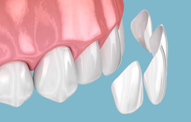 dental veneer placement