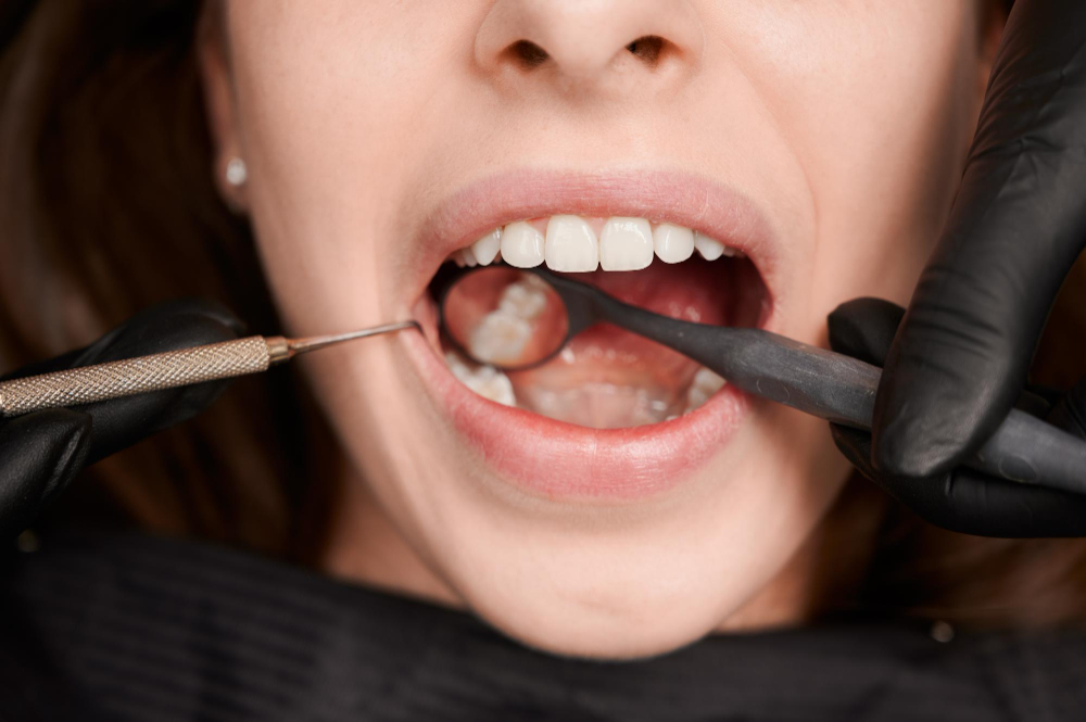 composite cavity fillings